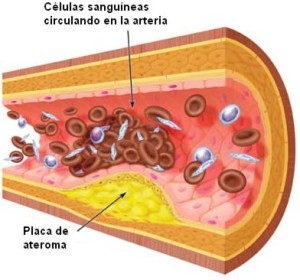 arteriosclerosis-2