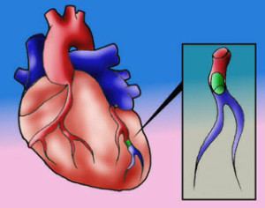 infarto-2